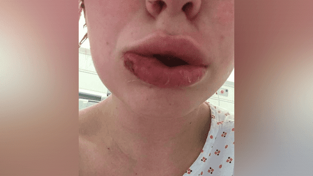 Mujer pagó 200 dólares para tener labios perfectos, pero cirujano se los dejó deformados [FOTOS]