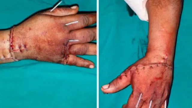 El hombre llegó al hospital con ambas manos colgando de sus muñecas, pero los médicos trabajaron durante horas para volver a colocar sus extremidades. Foto: Media Drum World / Newslions Media.
