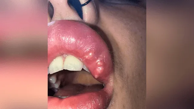 Mujer adicta a cirugías se rellena sus labios exageradamente y termina infectado de pus [FOTOS]