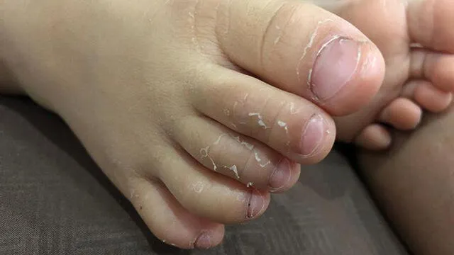 La descamación de pies y mano es otro de los síntomas que se presentan durante la segunda semana de la enfermedad de Kawasaki. (Foto: Shutterstock)