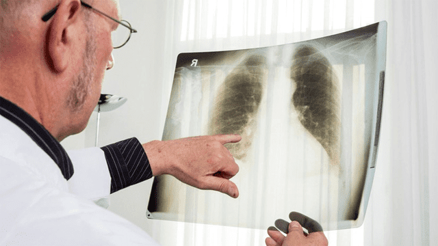 Fumó por 30 años y quiso donar sus pulmones: los rechazaron porque estaban podridos [VIDEO]