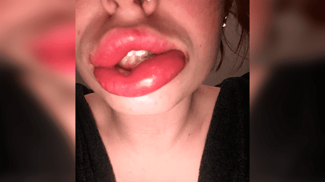 Mujer pagó 200 dólares para tener labios perfectos, pero cirujano se los dejó deformados [FOTOS]