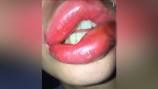 Mujer pagó 200 dólares para tener labios perfectos, pero cirujano se los dejó deformados [FOTOS]