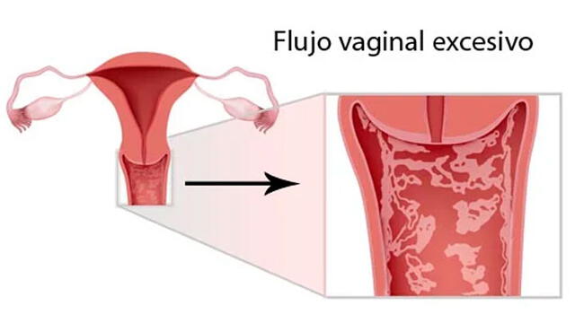 Vulvovaginitis es la enfermedad de transmisión sexual más frecuente en México