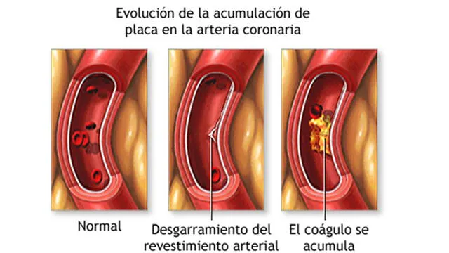 Formación de plaza que produce el infarto de miocardio. Foto: ADAM / captura de la web Medlineplus.