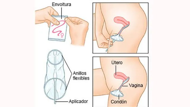 Sexo seguro: aprende a usar un condón femenino y conoce sus ventajas [VIDEO]