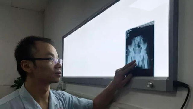 El médico Wang Shengxing examina la imagen de rayos x de la pelvis del menor. Foto: AsiaWire.