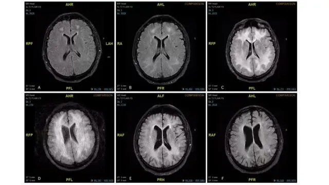 Las fases de la destrucción del cerebro dentro del control del paciente. Foto: The Sun