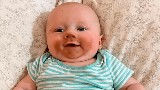 Bebé con el rostro manchado de bronceador.