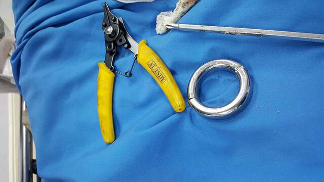 Médicos chinos tuvieron que usar maquinaria especial para retirar el anillo del miembro del anciano. Foto: referencia Dewsbury / Jakchai Banyensakul
