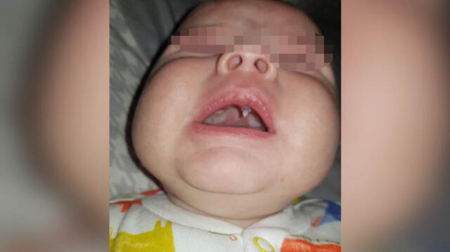 Insólito: a un bebé le creció un ‘colmillo’ durante la noche [FOTO]