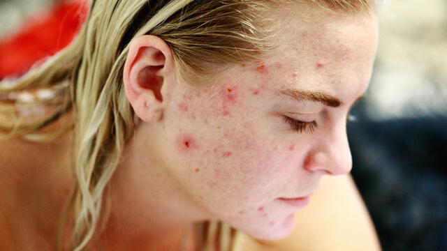 El acné es una enfermedad de la piel