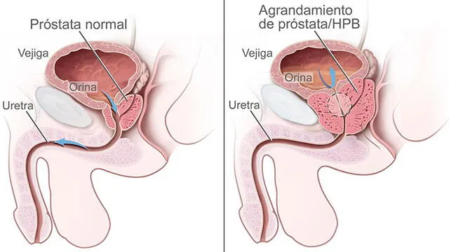 El agrandamiento de la próstata cierra el conducto urinario.