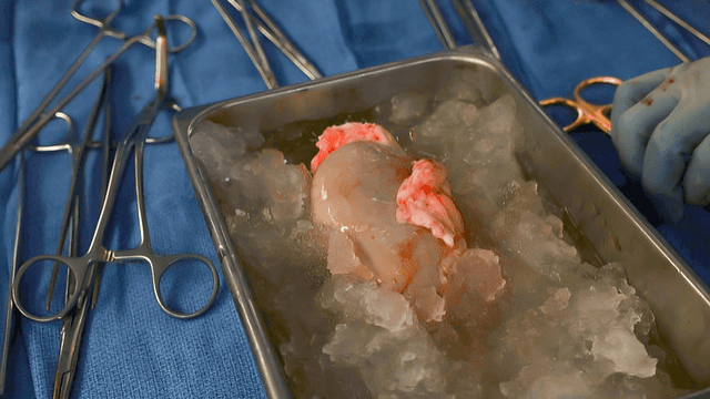Este trasplante, realizado el 16 de marzo, destaca por la utilización del órgano de un cerdo genéticamente modificado para ser compatible con el cuerpo humano. Foto: AFP   