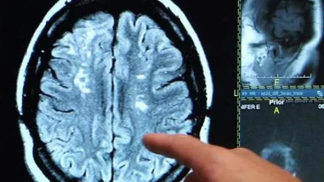Una de las afectaciones neurológicas por COVID-19 es la "niebla cerebral". (Foto: 20 Minutos)