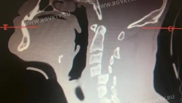Consecuencias de la terrible caída que se hizo viral.