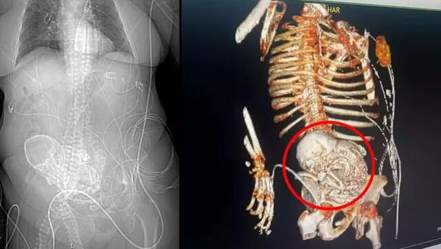  Tras una tomografía en 3D, los médicos descubrieron que Daniela Almeida tenía un bebé de piedra. Foto: Globo   