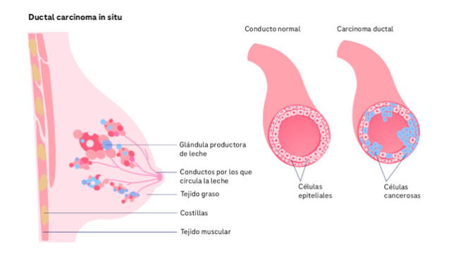 Con el cáncer de mama, las células del tejido mamario crecen de manera descontrolada, formando tumores malignos. Foto: Roche pacientes   