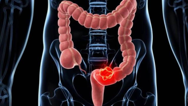 Las células cancerígenas pueden formar tumores que crecen dentro del intestino grueso, obstruyendo el paso de las heces. Foto: ABC   