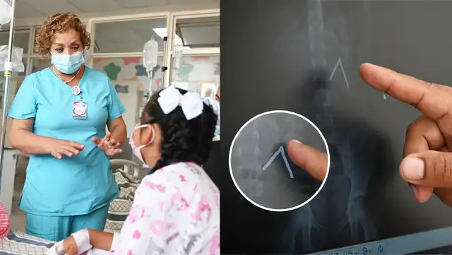  Menor confesó en el INSN que comió los imanes tras ver un video en internet. Foto: Minsa.   