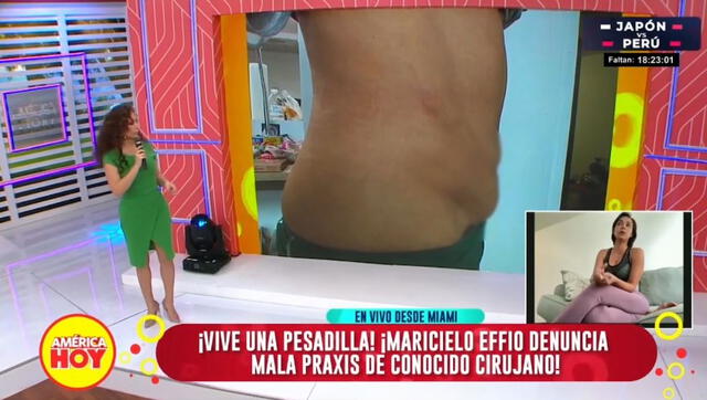  Así quedó abdomen de Maricielo Effio. Foto: captura/América TV    
