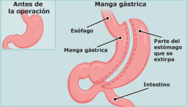 Esquema de un estómago antes y después de la cirugía. (Foto: KidsHealth)