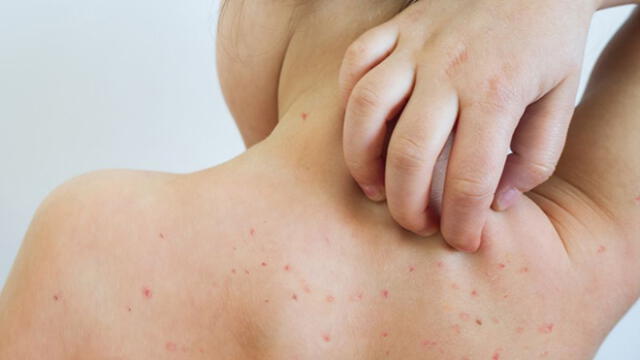 ¿Cómo distinguir entre el sarampión y la varicela?: Conoce las cinco diferencias