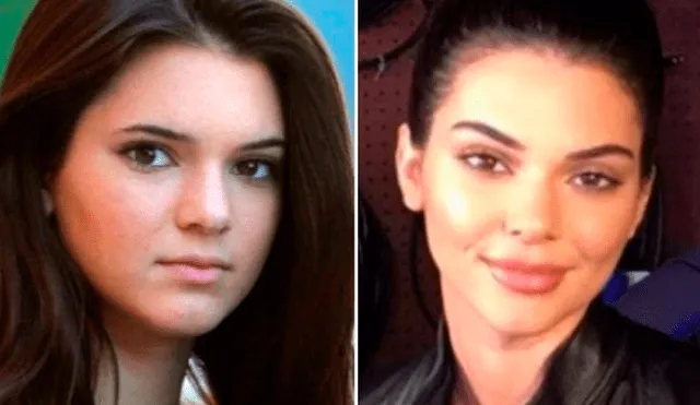 Kendall Jenner, antes y después de cirugías.