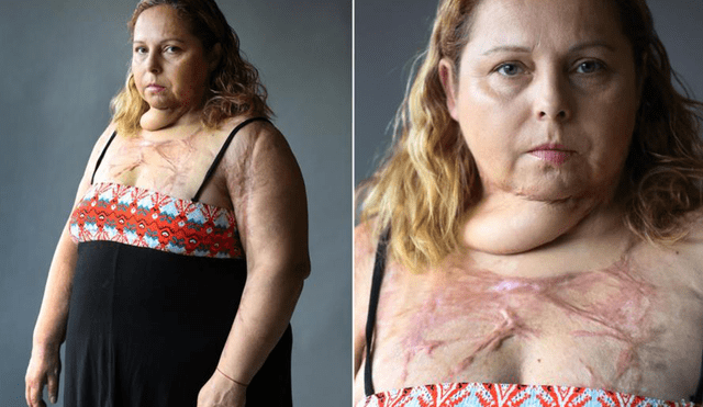 Intento de feminicidio: mujer pasó por más de 50 operaciones y casi pierde los brazos 