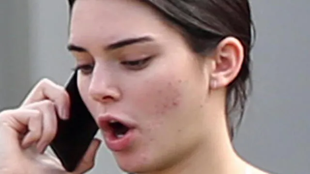 La modelo Kendall Jenner sufre por secuelas del acné en su rostro. Fuente: Instagram