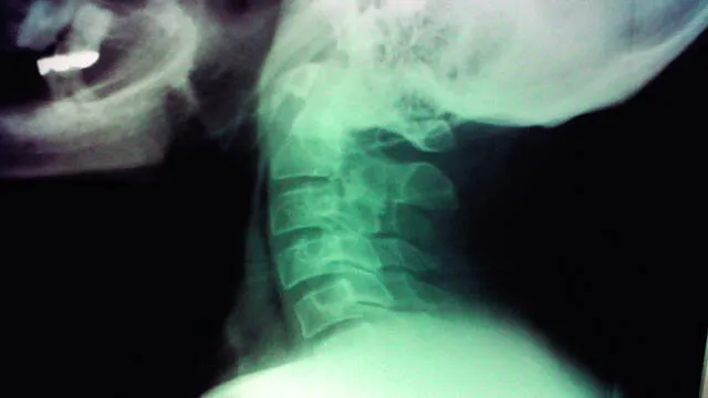 Radiografía de cuello humano. Foto: difusión