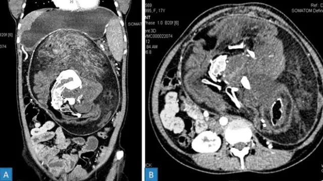 Tomografía computarizada del abdomen de la joven. Se puede ver a la compleja masa de su 'gemelo'. Imagen: BMF Case Reports.