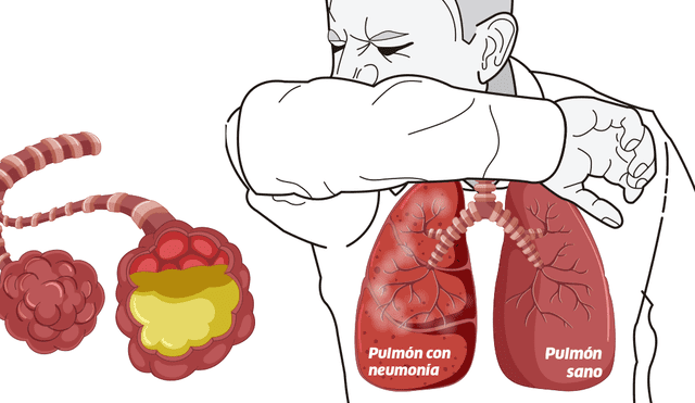 El virus se puede alojar en las vías respiratorias superiores o inferiores.