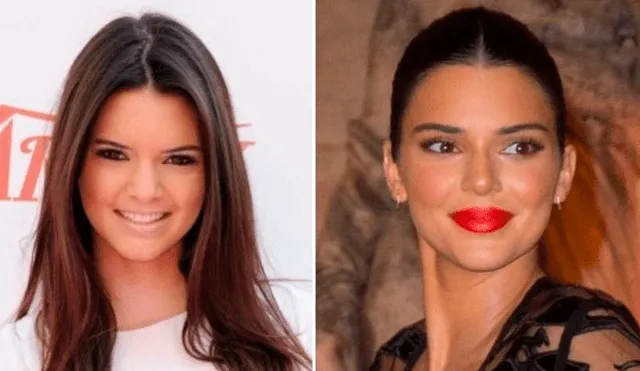 Kendall Jenner, antes y después de cirugías.