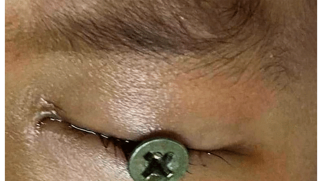 Los médicos consiguieron retirar el tornillo del ojo del menor. Foto: Viral Press.