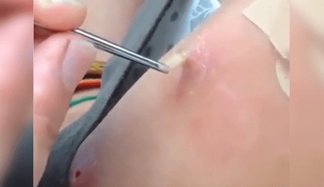 Facebook viral: espeluznantes criaturas son extraídas del brazo de una mujer que dejan en shock a doctor [VIDEO]