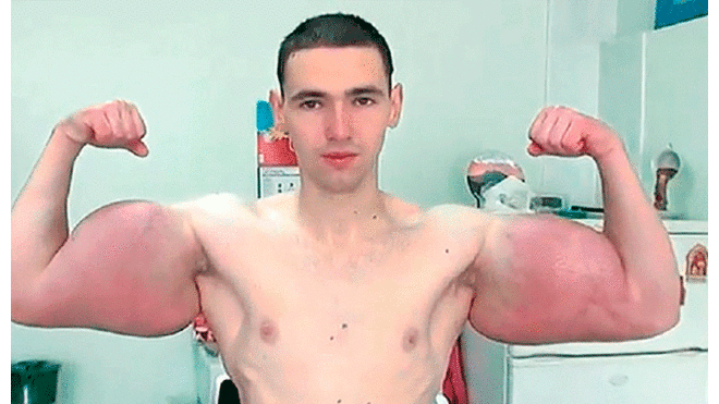 Qué es el Synthol, la peligrosa sustancia que se inyectó el “Popeye” ruso para aumentar sus músculos [VIDEO]