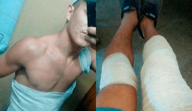 El joven quedó con graves quemaduras luego que el líquido ácido de la batería se impregnara en su cuerpo. (Foto: Facebook)