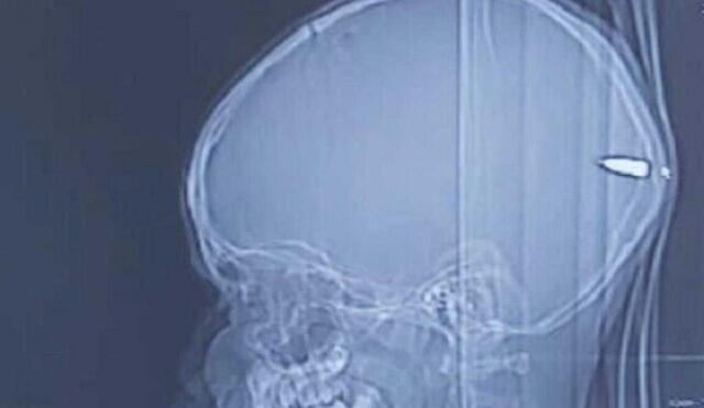 Una imagen de rayos x muestra la bala alojada en el cerebro del niño de nueve años. Foto: Hospital Universitario Hadassah (The Times of Israel)