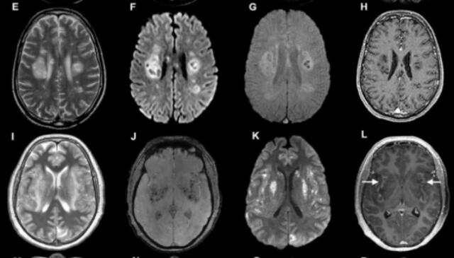 Escáneres cerebrales de pacientes con coronavirus que fueron incluidos en el estudio.Foto: Difusión.