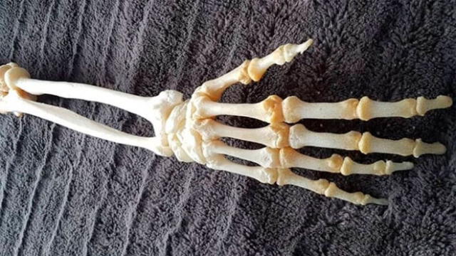 Hombre conserva los huesos disecados del brazo que le amputaron [FOTOS]