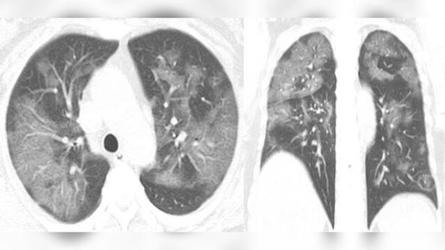 Tomografías muestran el daño que causa el coronavirus en los pulmones