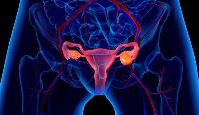 Más de 200 000 mujeres son diagnosticadas con cáncer de ovario en el mundo | Getty Images