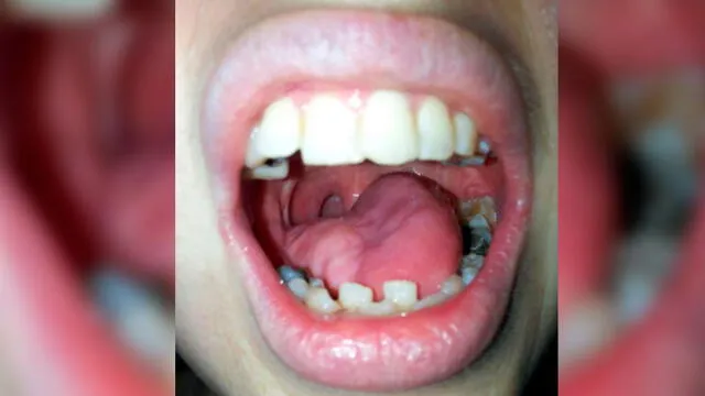 Le extirparon parte de su lengua por un cáncer y ahora tiene una nueva hecha con piel de su brazo