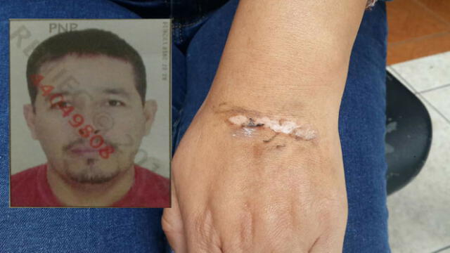 Sujeto le quema la mano a exesposa por reclamar pensión de hijo en Chimbote