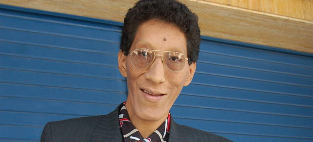 Margarito Machacuay: el hombre más alto del Perú se encuentra en cuidados intensivos [VIDEO]