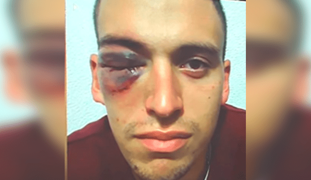 Arquero recibió brutal golpe en la cara y terminó con un edema en la retina [VIDEO]