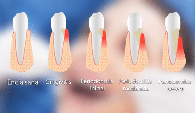 ¿Cómo se genera la gingivitis y cuál es el tratamiento?