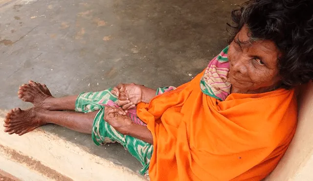 La anciana nació con 19 dedos en los pies y 12 en las manos. Una extraña enfermedad que la ha convertido en el centro de burlas y discriminación en un pueblo de la India.