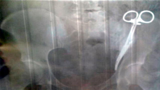 Mujer tiene tijeras quirúrgicas en su abdomen desde hace 23 años